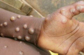 Monkeypox-in-US