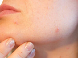 Remedy-for-pimples-and-acne