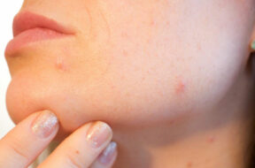 Remedy-for-pimples-and-acne