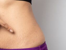 why-some-people-get-stretch-marks-and-others-dont