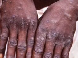 92-monkeypox-cases-confirmed-in-12-countries-may-spread-globally-who-latest-eng-news-1476317