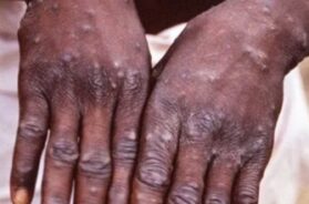 92-monkeypox-cases-confirmed-in-12-countries-may-spread-globally-who-latest-eng-news-1476317