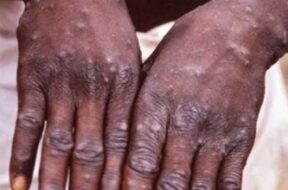 92-monkeypox-cases-confirmed-in-12-countries-may-spread-globally-who-latest-eng-news-1476317