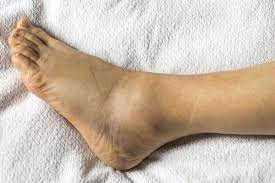  તમારા પગમાં વારંવાર સોજા આવે છે? તો કોલેસ્ટ્રેલની છે અસર, પગની નસ થઈ શકે છે બ્લોક