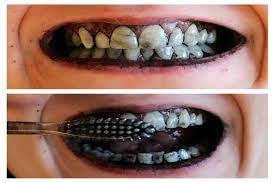 શું તમે દાંત કાળા કરવાની પરંપરા વિશે જાણો છો, હાલ પણ કેટલાક દેશોમાં દાંત કાળા કરવું શુભ માનવામાં આવે છે