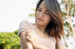 Asian,Woman,Scratching,Her,Arm;,Concept,Of,Dry,Skin,,Allergic