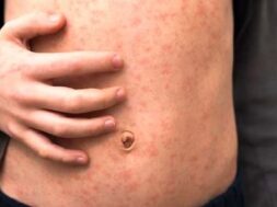 measles symptoms