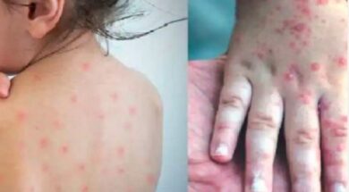 measles in gujarati