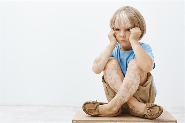 બાળકોના ચહેરા પરના સફેદ ડાઘને નજરઅંદાજ ન કરો,આ vitiligo ના લક્ષણો હોઈ શકે છે