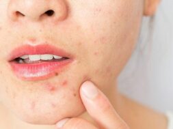 surprising-causes-of-adult-acne-00-alt-722×406