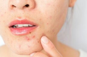 surprising-causes-of-adult-acne-00-alt-722×406