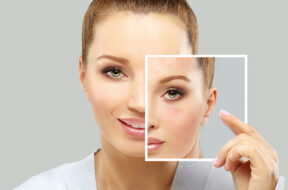 Acne-Treatments