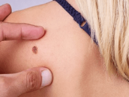 skin cancer