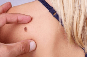 skin cancer