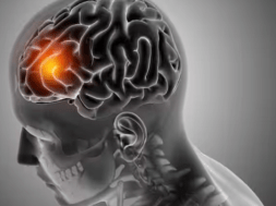 BRAIN STROK