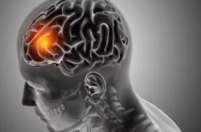 BRAIN STROK