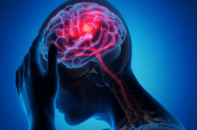 brain strok