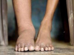 filariasis