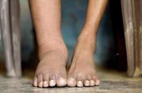 filariasis