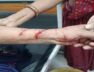 Vav, monkey bite