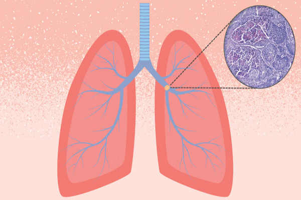 લિક્વિડ બાયોપ્સી શું છે, તે ફેફસાંના કેન્સરની સારવારને કેવી રીતે સરળ બનાવે છે