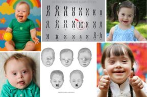 Down Syndrome