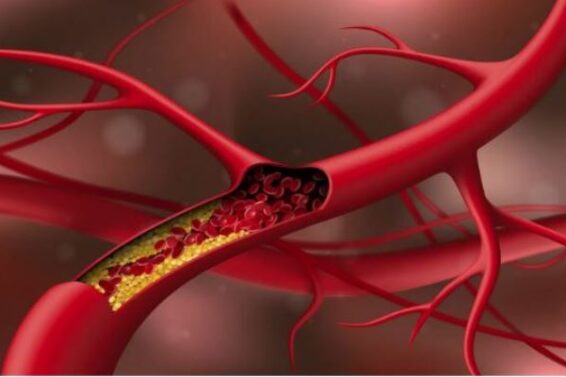 Cholesterol